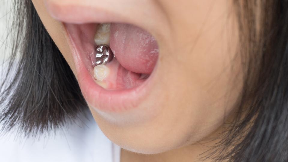 A photograph of silver amalgam crown dental filling teeth in the mouth. 